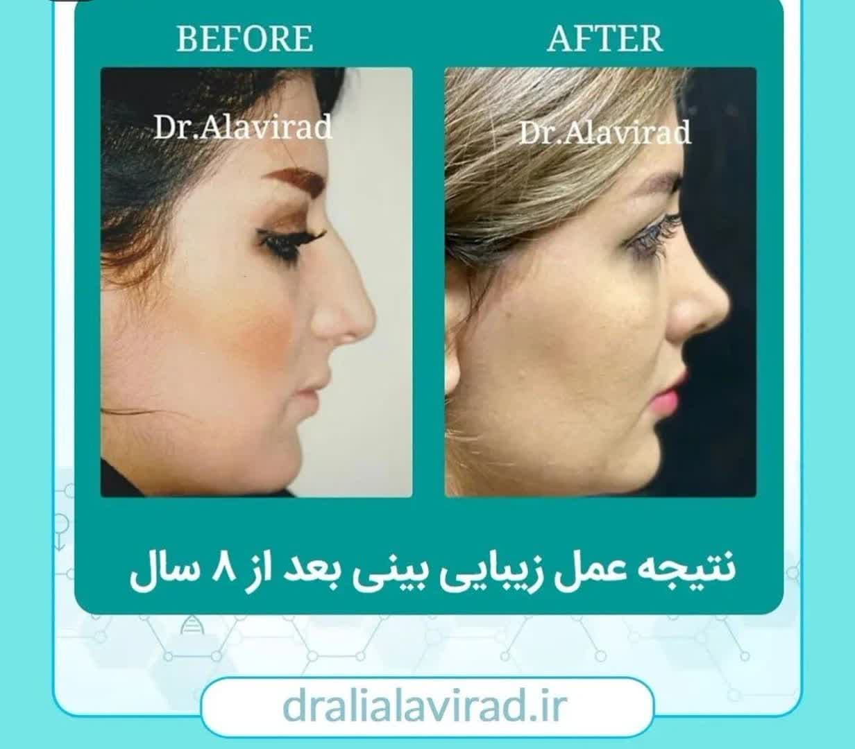 بینی فانتزی