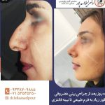 نمونه عمل بینی استخوانی با قوز زیاد