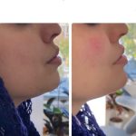 فیلر چانه دکتر صفوی