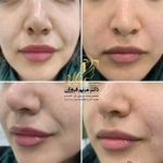 تزریق فیلر لب شیراز . دکتر فروزان