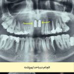 بهترین دکتر ایمپلنت قم