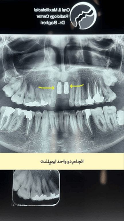 بهترین دکتر ایمپلنت قم