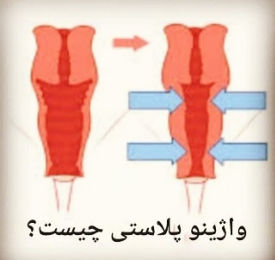 بهترین دکتر تنگی واژن قم