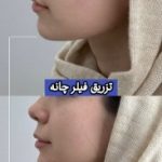تزریق فیلر به چانه اراک1