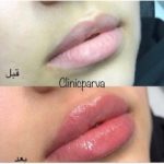 دکتر تزریق فیلر اراک2