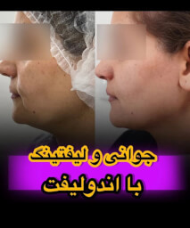 اندولیفت کرمان2