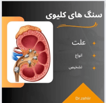 بهترین دکتر درمان سنگ کلیه کرمان