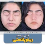 رینوپلاستی بندرعباس