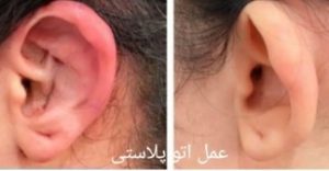 بهترین جراح اتوپلاستی شیراز