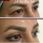 بهترین دکتر جراح افتادگی پلک شیراز -