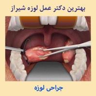 بهترین دکتر عمل لوزه شیراز -