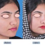 عمل زیبایی بینی بندرعباس