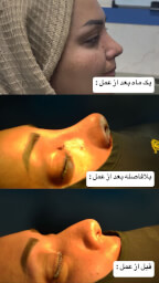 عمل بینی گوشتی در یزد نمونه قبل و بعد