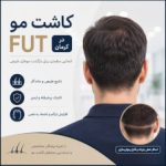 کاشت مو اف یو تی کرمان