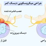 عمل میکروسکوپی دیسک کمر شیراز